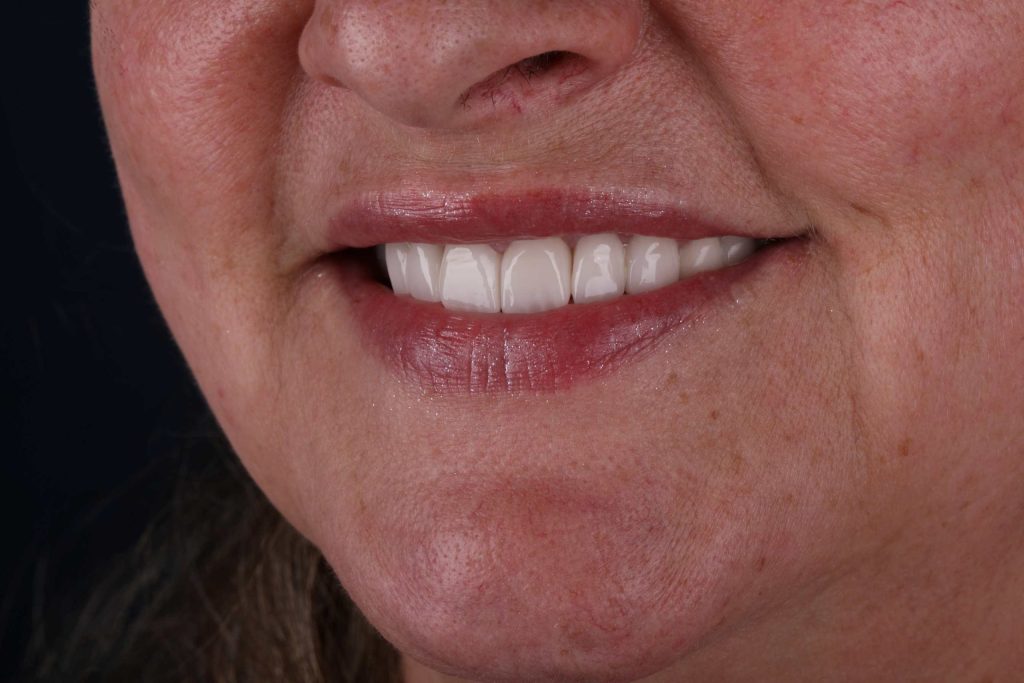 Пациент после Digital Smile Design в Турции в 2025 году — визуализация новой улыбки