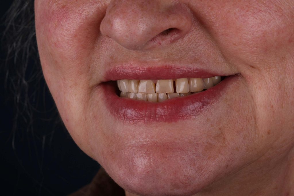 Пациент до Digital Smile Design в Турции — естественные зубы без цифрового моделирования