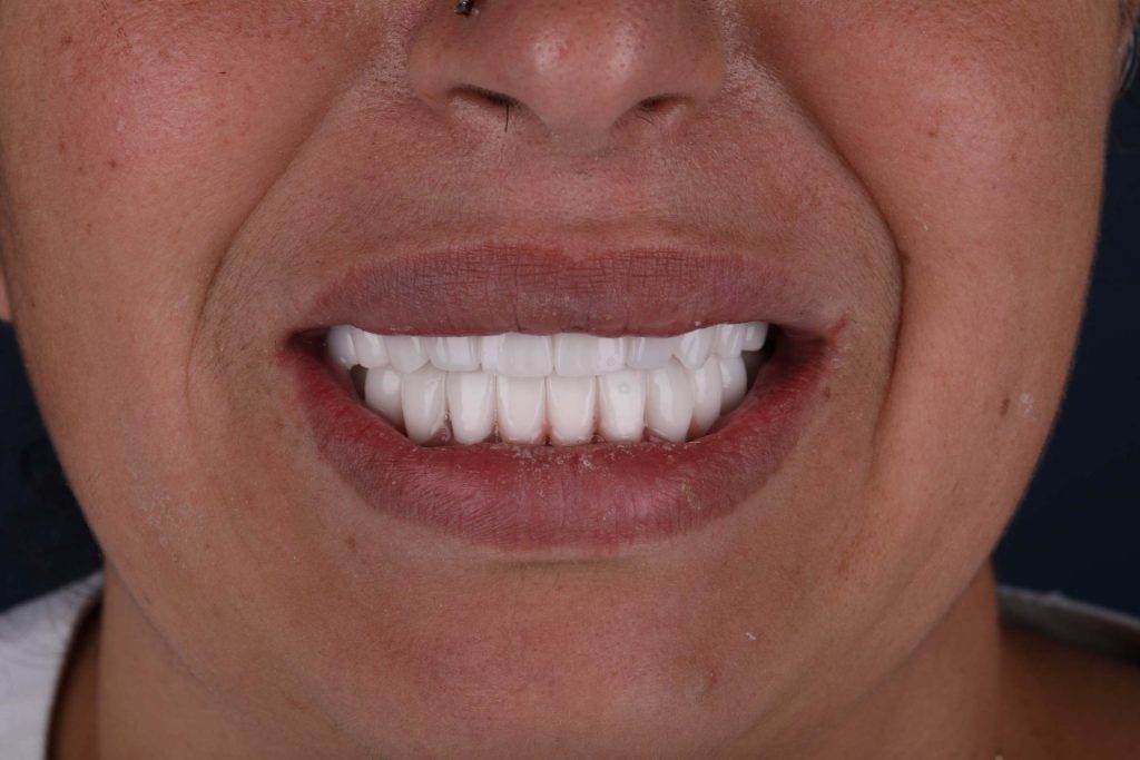 Пациент после отбеливания зубов в Турции — результат процедуры smile makeover