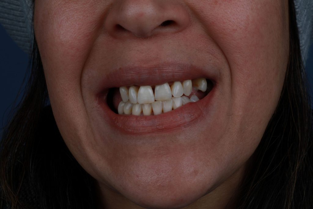 Улыбка до Hollywood Smile в Турции — история и тренды 2025, фото до