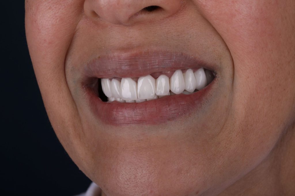 Результат Hollywood Smile в Турции — современные тренды 2025, фото после