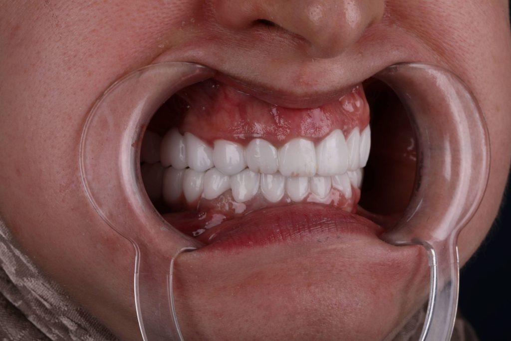 Пациент после Hollywood Smile в Анталье — результат Голливудская улыбка в Анталье фото после