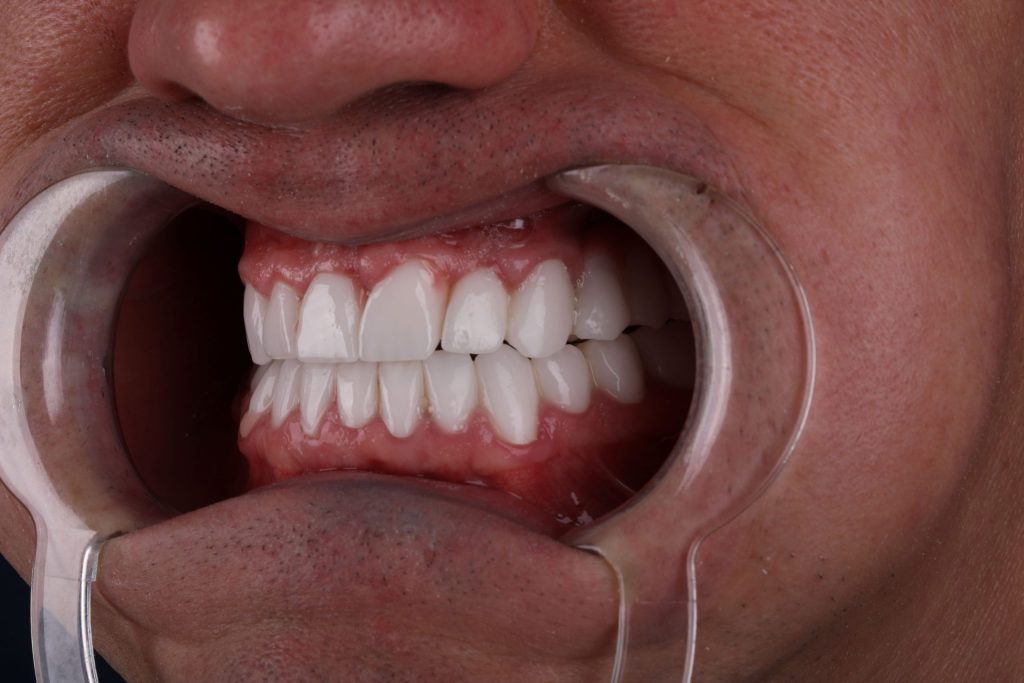Пациент после Hollywood Smile в Анкаре — фото после процедуры 2025