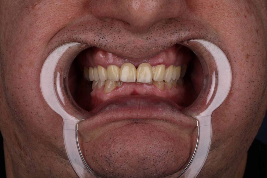 Пациент 50+ до процедуры — Голливудская улыбка 50 в Турции 2025