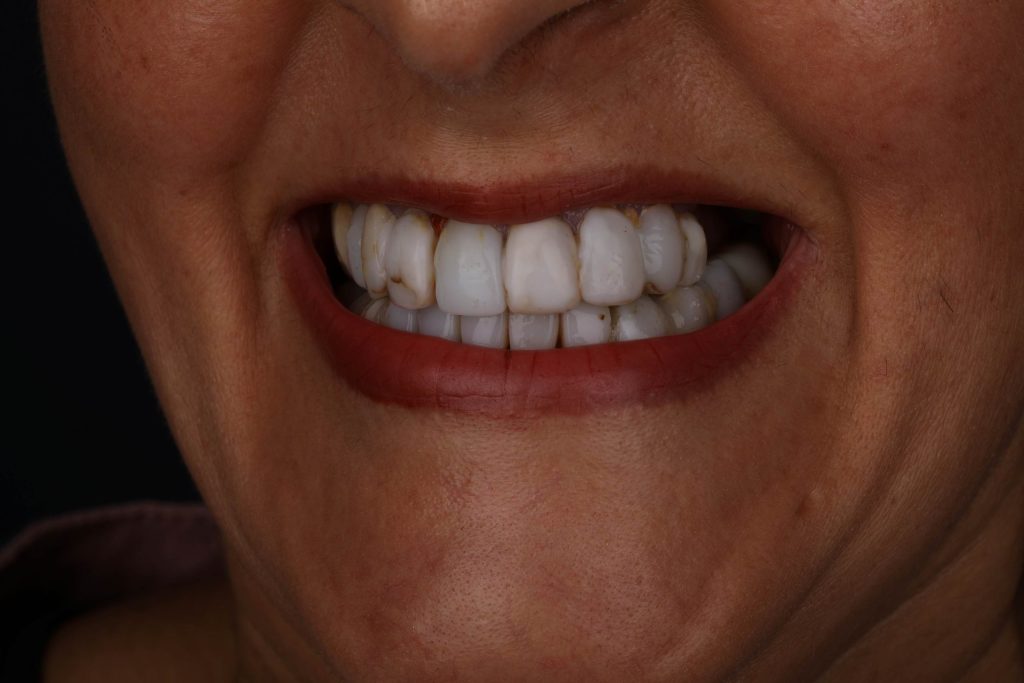 Улыбка пациента до Smile makeover vs Hollywood Smile в Турции — исходное состояние зубов 2025