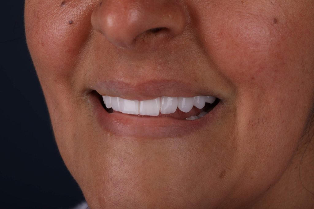Результат Smile makeover vs Hollywood Smile в Турции — красивая и белоснежная улыбка 2025