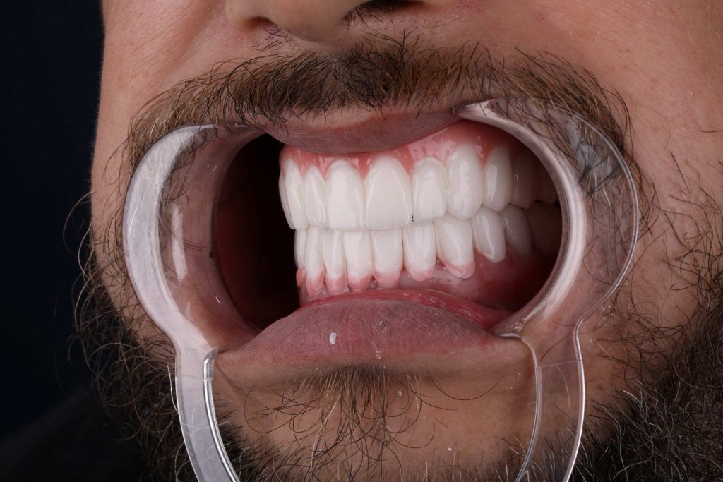 Результат после Smile makeover в Турции — белоснежные и ровные зубы 2025