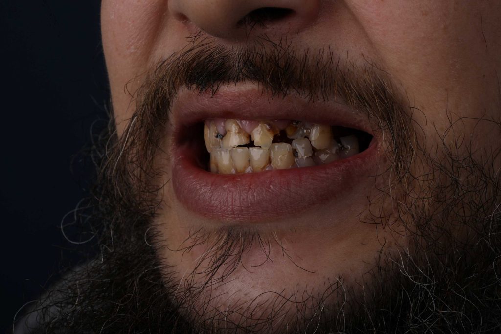 Улыбка пациента до Smile makeover в Турции — неровные зубы и потемневшая эмаль 2025
