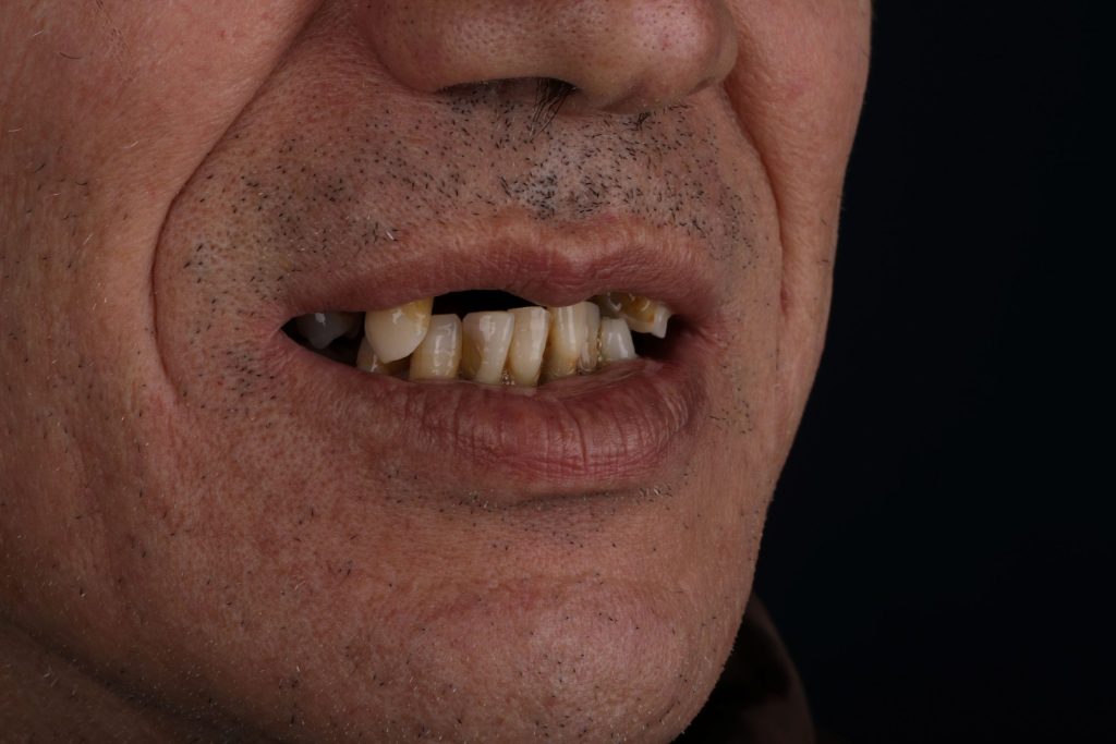 Улыбка пациента до Digital Smile Design в Турции — естественное состояние зубов 2025