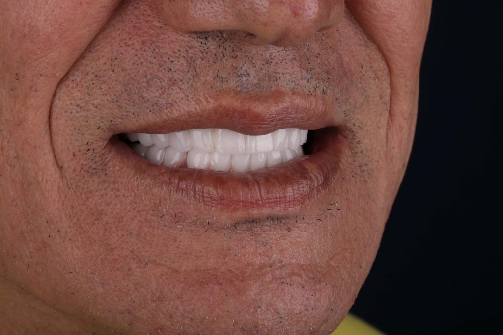 Результат Digital Smile Design в Турции — визуализация новой улыбки 2025