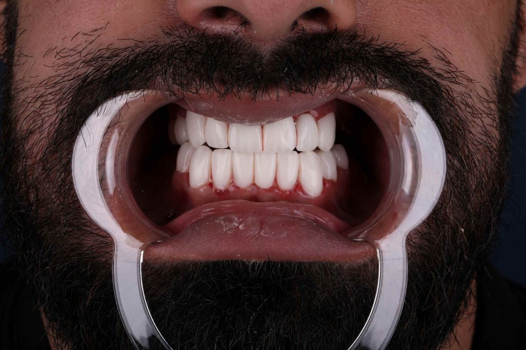 Пациент после процедуры — Голливудская улыбка Турция Польша фото после