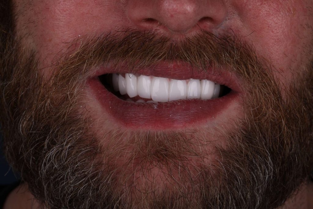 Пациент в Измире после Smile Makeover — фото после процедуры 2025