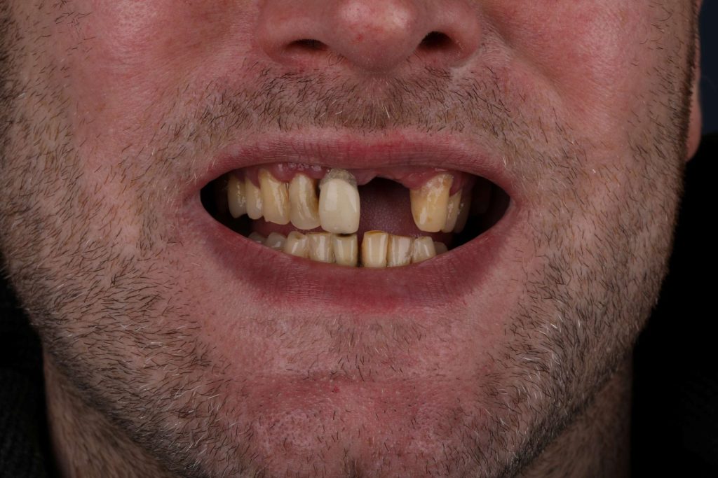 Пациент в Измире до Smile Makeover — фото до процедуры 2025